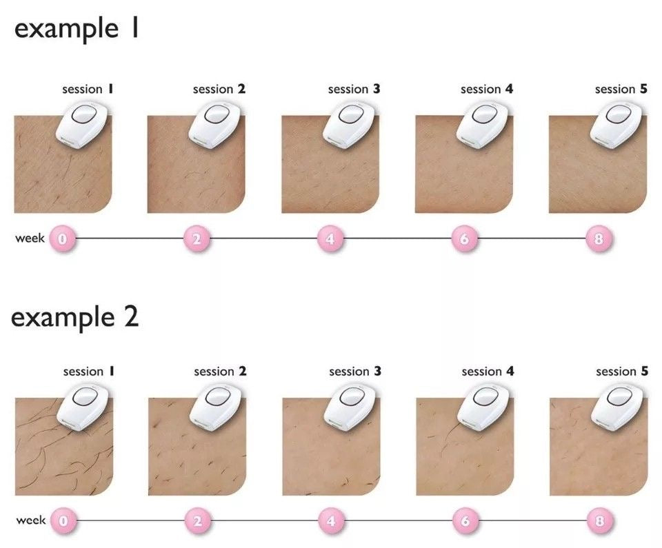 Depiladora Láser IPL